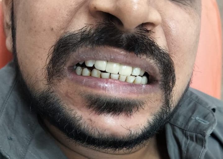 A missing front tooth, closed with a bridge, after treatment