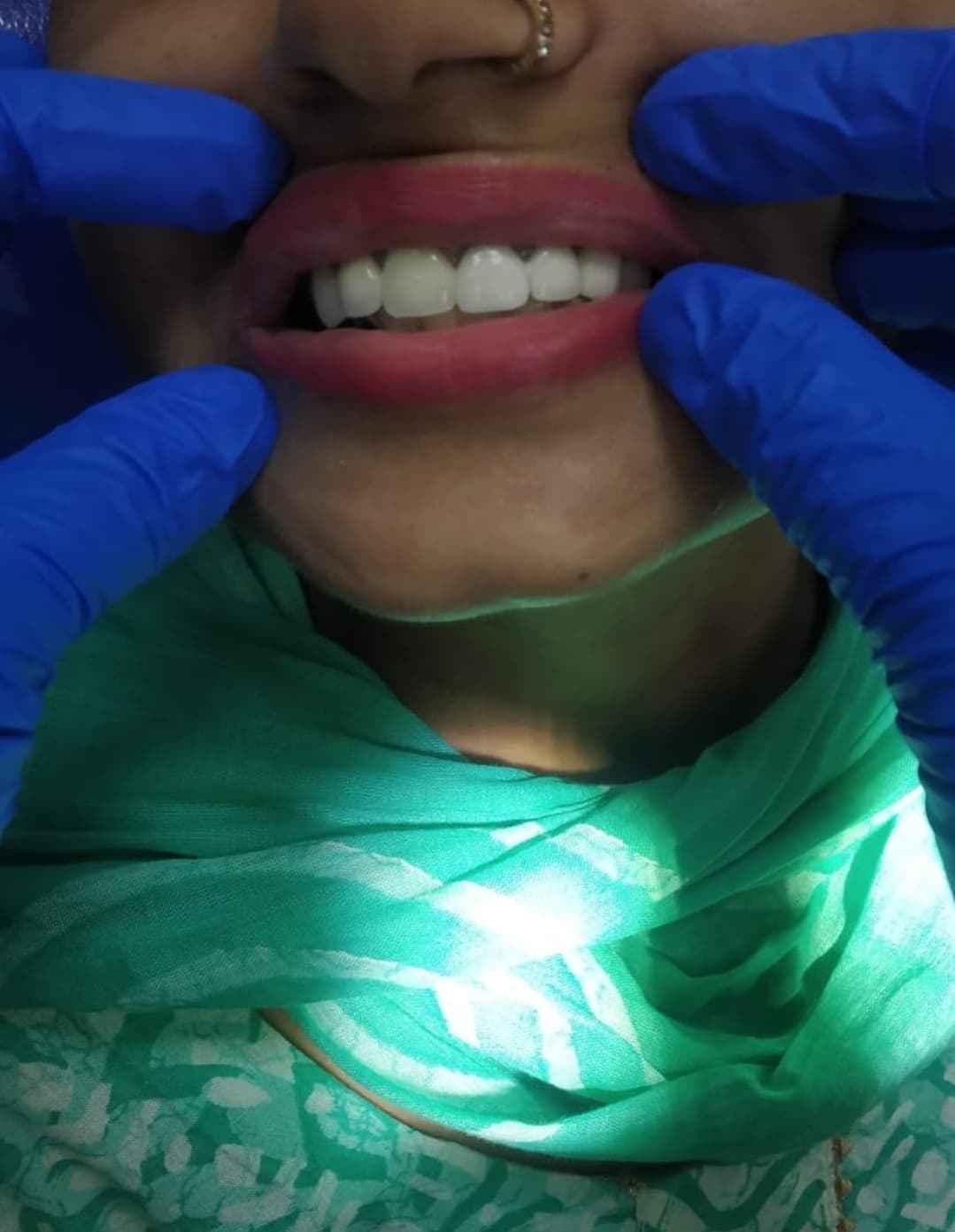 Ceramic crowns, after treatment