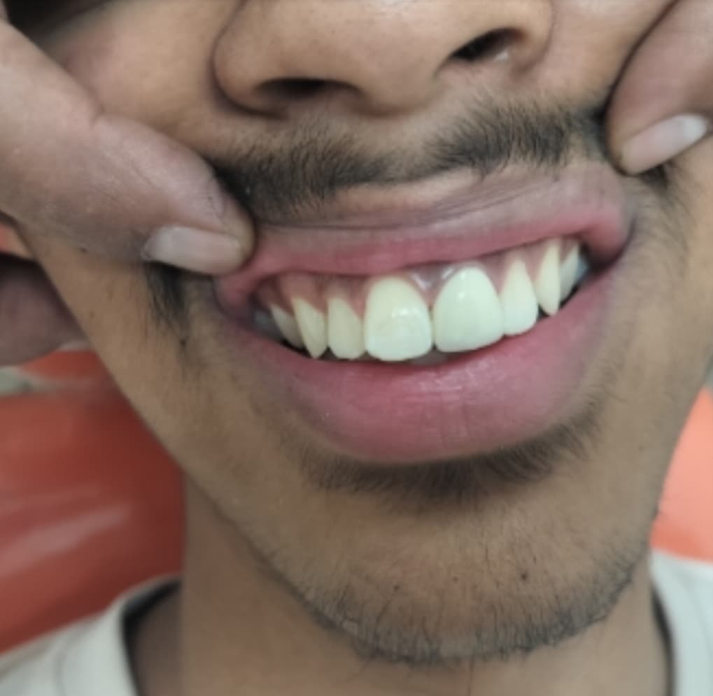Smile makeover, after treatment