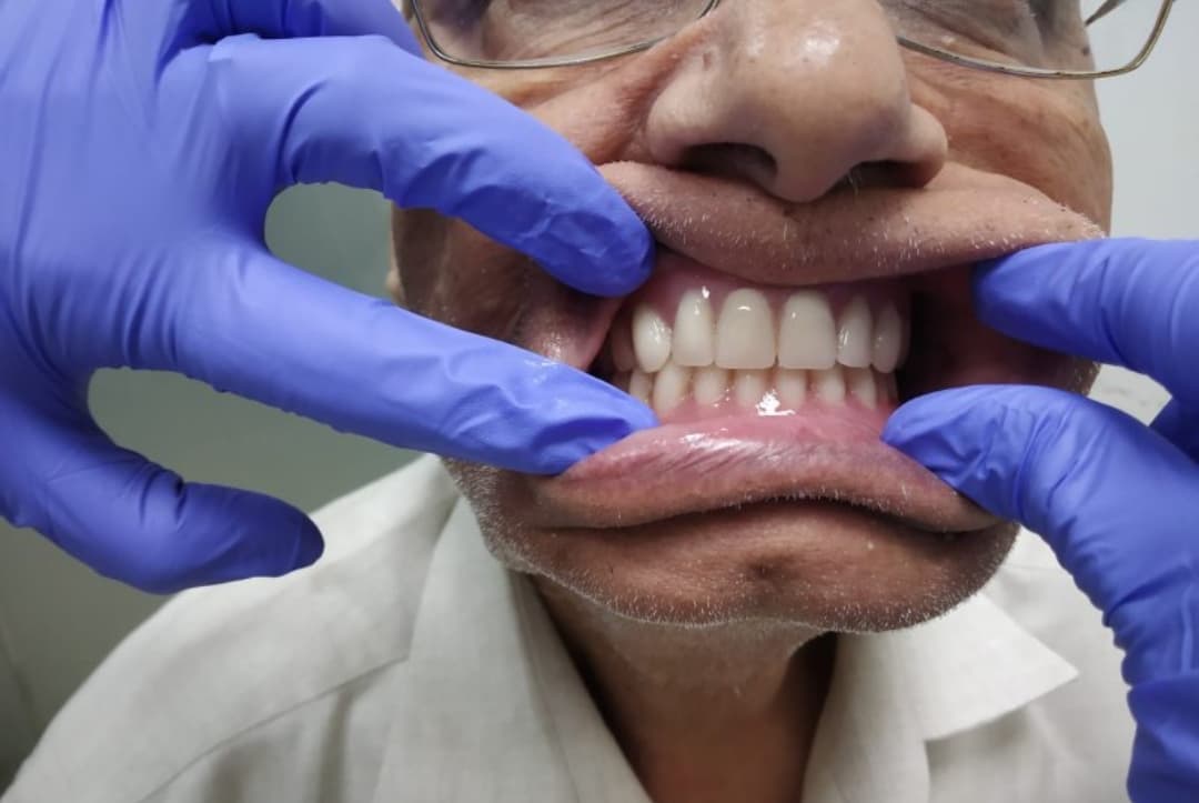 Complete dentures, after treatment