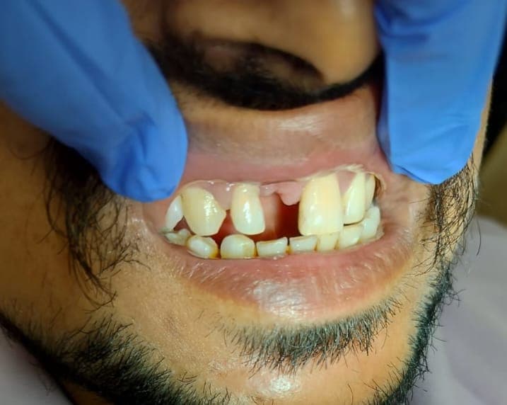 A missing front tooth, before treatment
