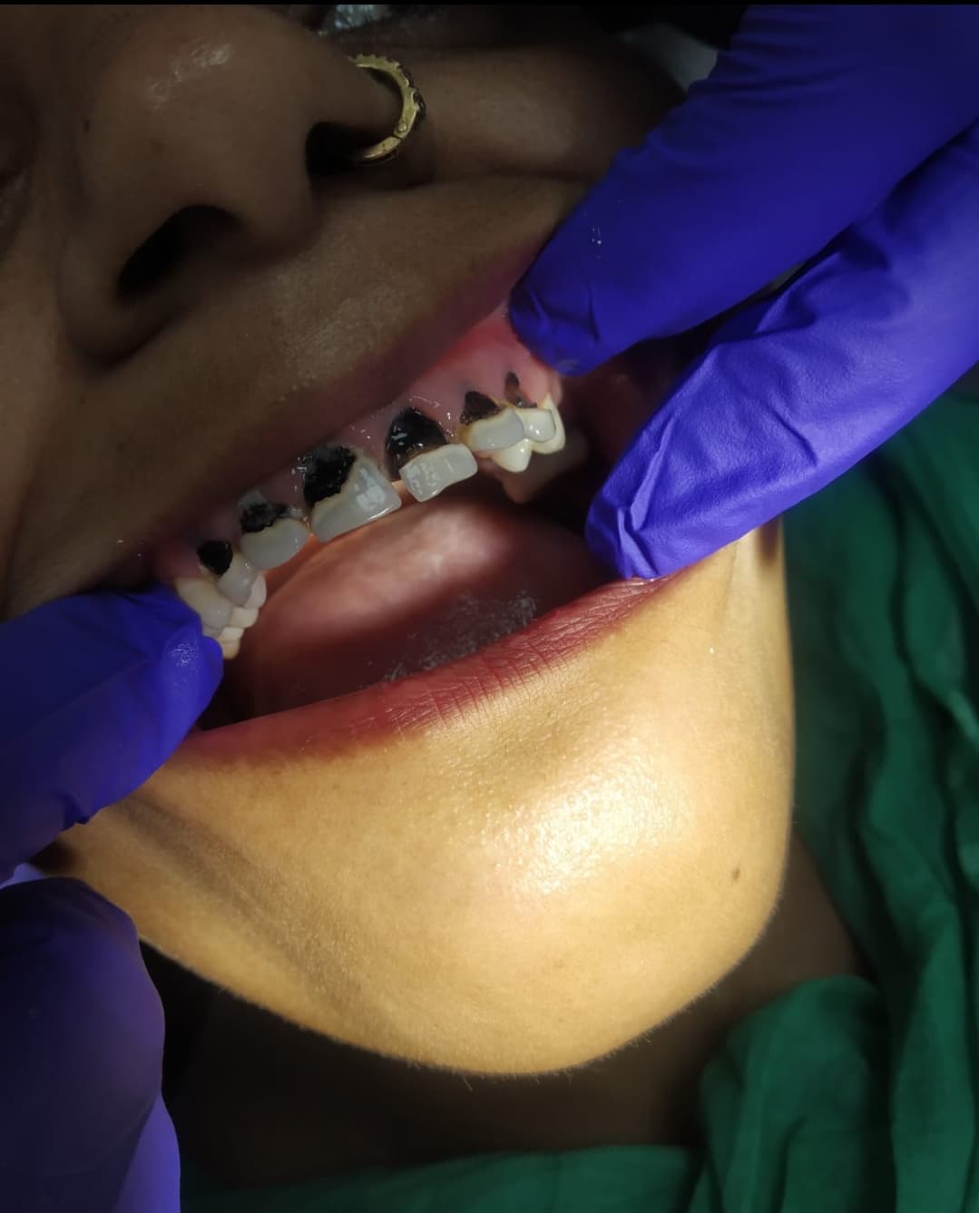 Ceramic crowns, before treatment