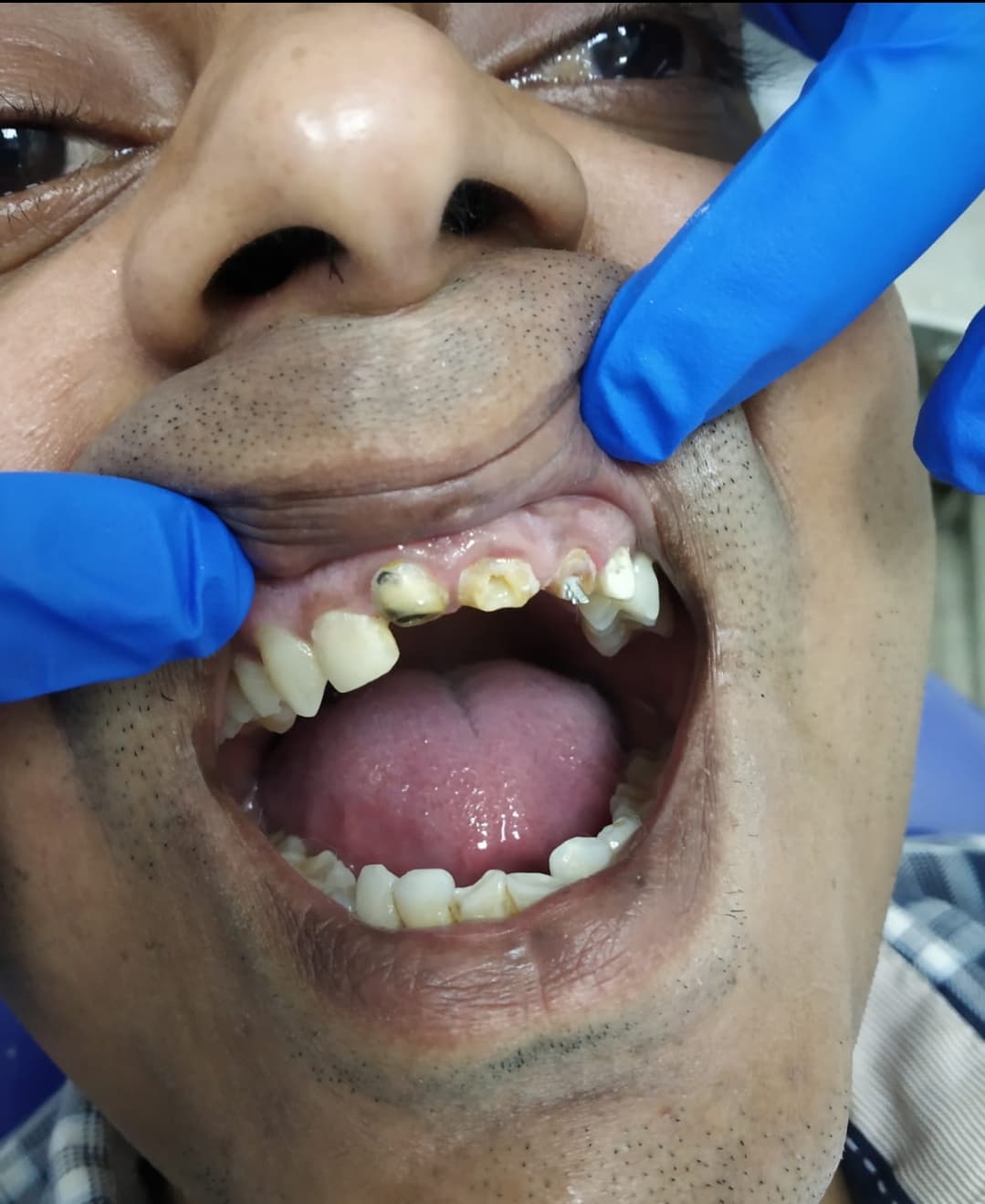 Full arch rebuild, before treatment