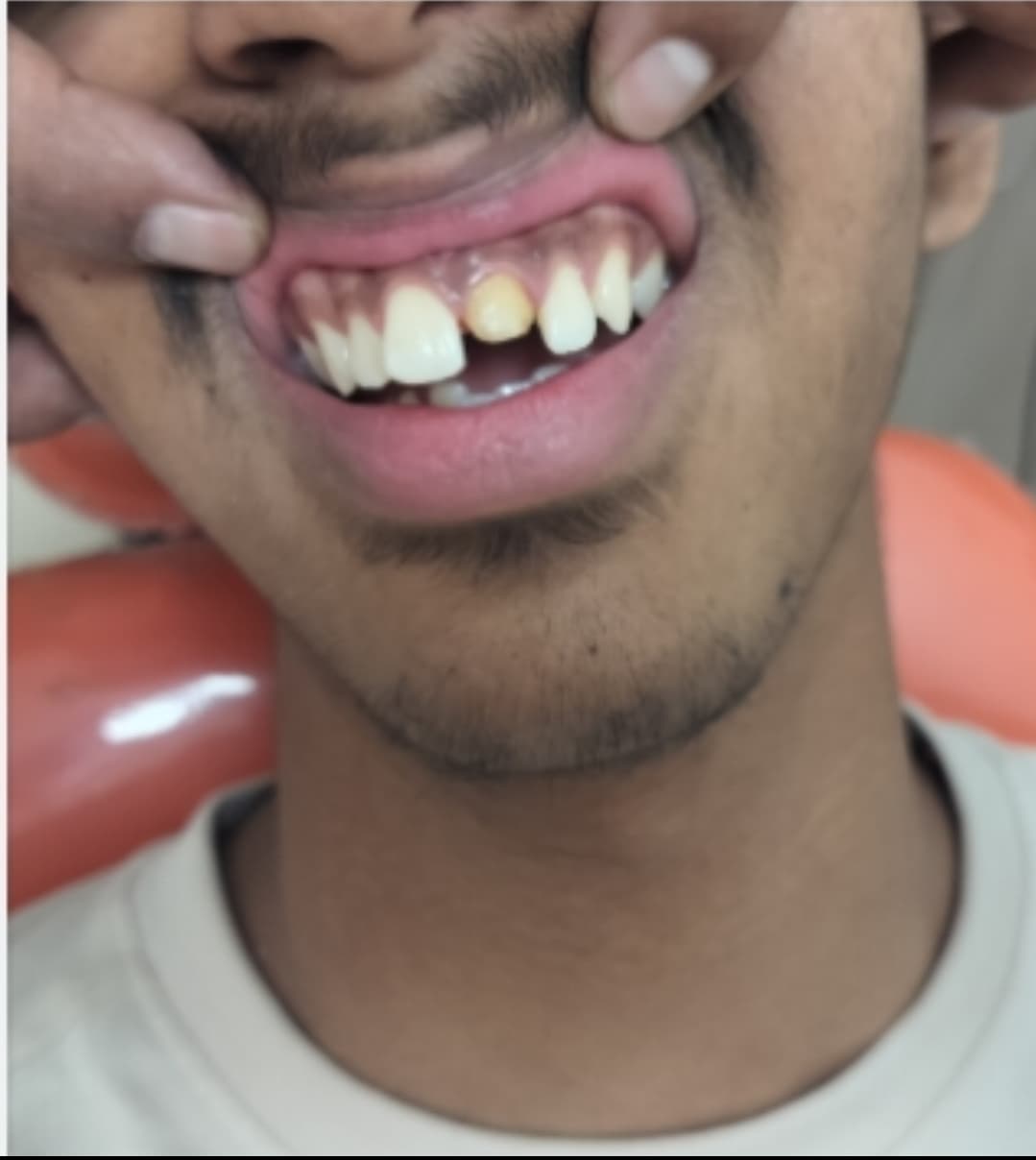 Smile makeover, before treatment