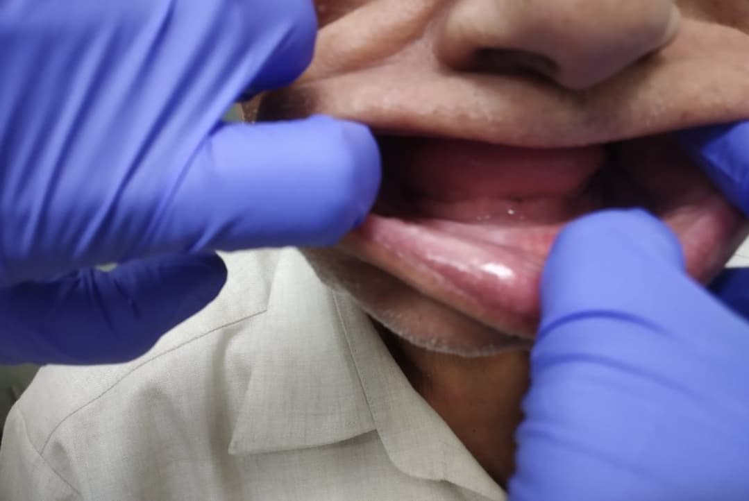 Complete dentures, before treatment